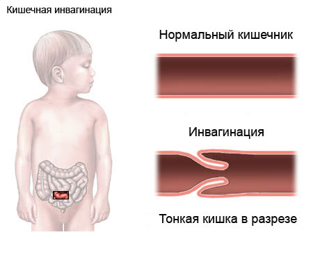 Развитие болезни у детей