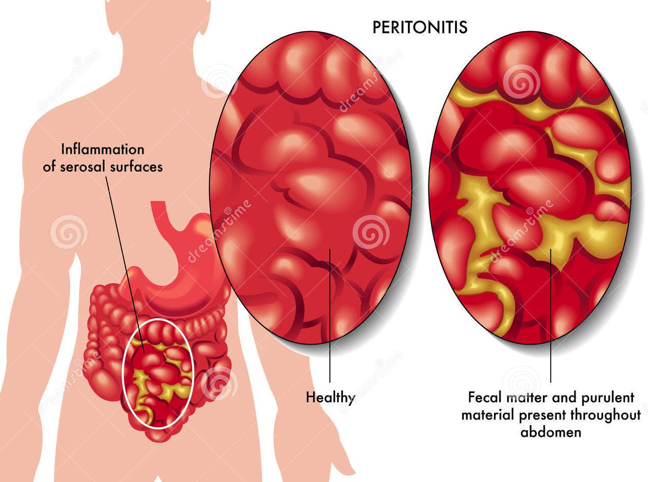 Когда возникает перитонит кишечника?