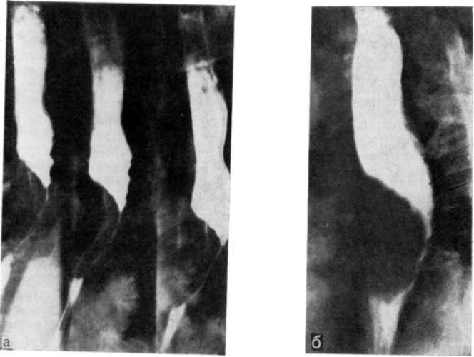 Опухоль на рентгеновском снимке