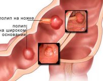 Признаки и лечение полипов в кишечнике