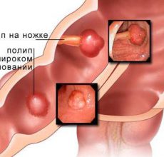 Признаки и лечение полипов в кишечнике