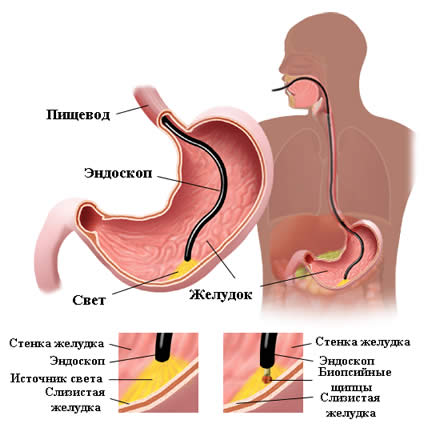 Схема проведения биопсии желудка