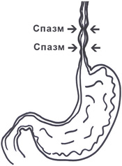 Схематичное изображение недуга