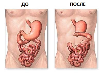 До и после проведения резекции желудка
