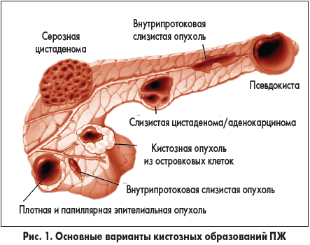 Виды кистозных образований