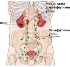 Разновидности и лечение лимфаденопатии брюшной полости