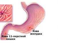 Способы лечения язвенной болезни желудка и двенадцатиперстной кишки