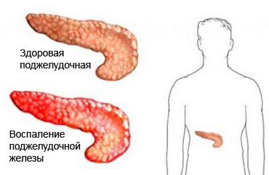 Железа во время панкреатита