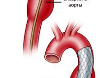 Что такое аневризма аорты брюшной полости?