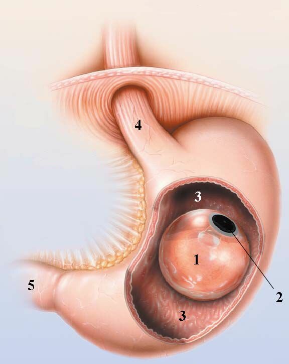 Баллон внутри органа