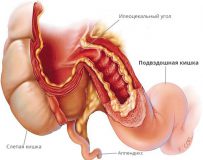 Причины и лечение атрофии слизистой желудка