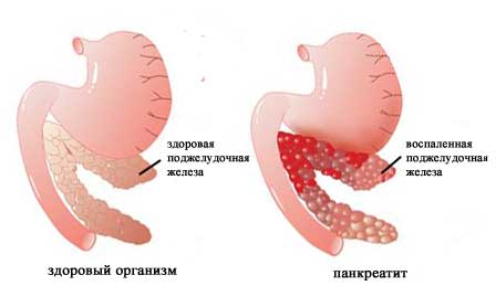 Воспаленная железа при панкреатите