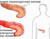 Особенности течения и лечения билиарного панкреатита