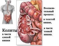 Как лечить колит кишечника?