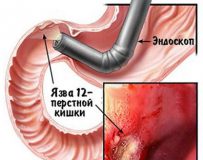 Что делать при эрозии двенадцатиперстной кишки?