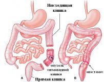 Признаки и методы лечения сигмоидита