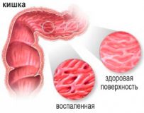 Каким должно быть лечение катарального колита кишечника?