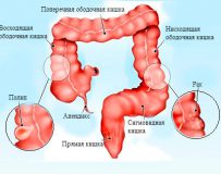 Что делать при воспалении сигмовидной кишки?