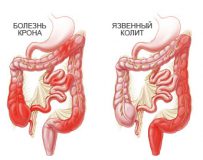 Как проходит лечение язвенного колита?