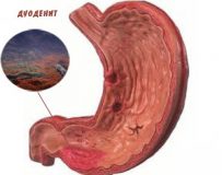 Разновидности и лечение гастродуоденита