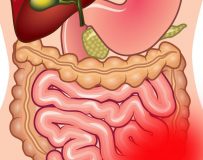 Ишемический колит — болезнь толстого кишечника