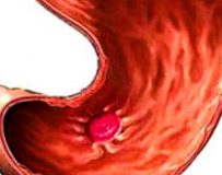 Очаговый гастрит — поражение участка слизистой желудка