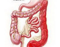 Неспецифический язвенный колит — воспаление слизистой