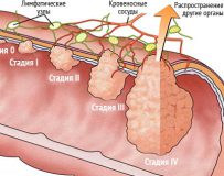 Лечение и прогноз аденокарциномы сигмовидной кишки