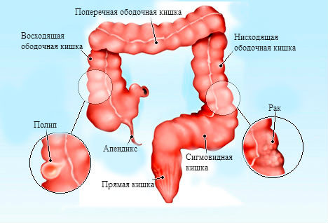Воспаление сигмовидного отдела