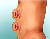 Характерные признаки и лечение грыжи белой линии живота