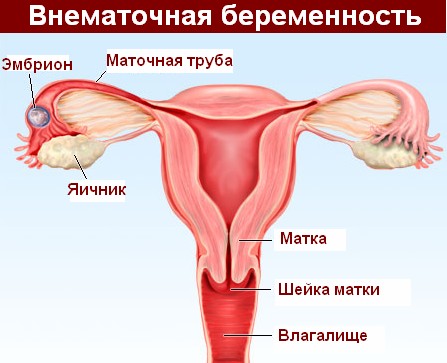 Эмбрион при внематочной беременности