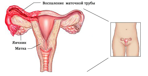 Воспаление трубы матки
