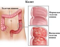 Чем лечить атрофический колит кишечника?