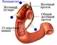 Стоит ли пить антибиотики при холецистите?