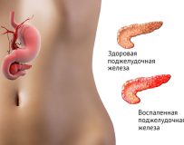 Виды и классификации панкреатита