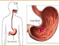 Этапы лечения при хроническом атрофическом гастрите