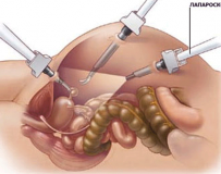 Какой будет жизнь после удаления желчного пузыря?