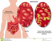 Причины развития гнойного перитонита