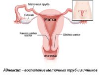 Рекомендации по лечению хронического аднексита