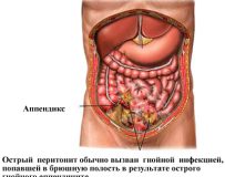 Причины и симптомы острого перитонита