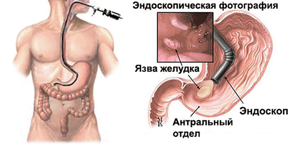 Процедура эндоскопии