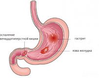 Лечение заболеваний луковицы двенадцатиперстной кишки