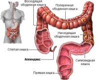 Возможные причины воспаления аппендикса