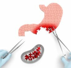 Четыре стадии рака желудка