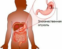 Какие причины рака желудка могут быть?