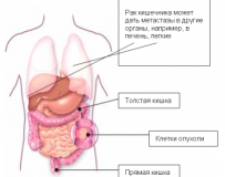 Прогноз при раке кишечника 4-ой стадии