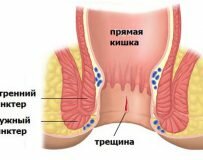 Причины боли в прямой кишке