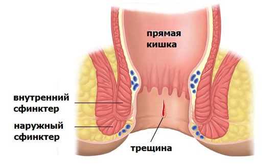 Трещина слизистой кишечника
