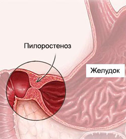 Пилоростеноз - патология строения желудка