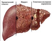 Лечение и прогноз при гепатоцеллюлярном раке печени